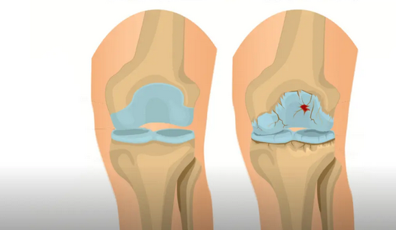 骨關節炎論文選題
